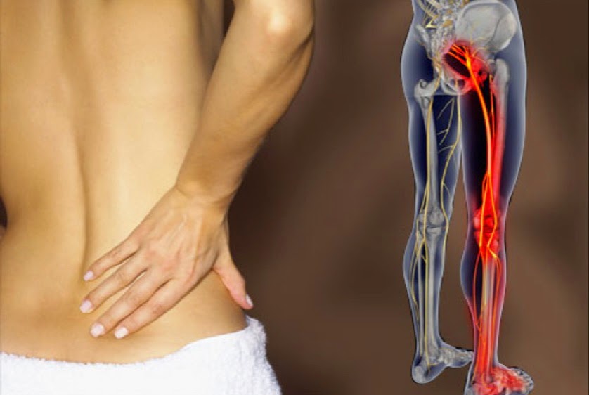 Banish Sciatica Pain with MSK Centre in Waterloo , ON